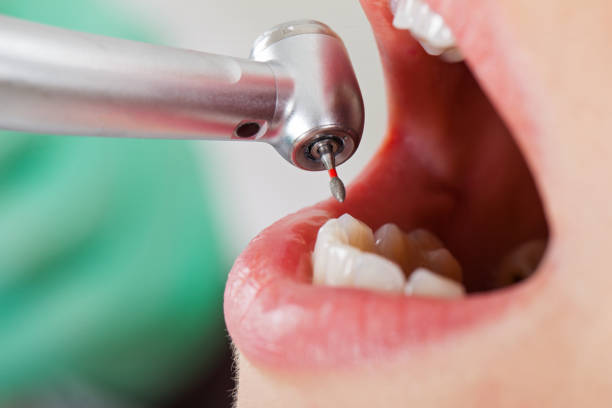 Best Emergency Tooth Extraction in Riverview, MI